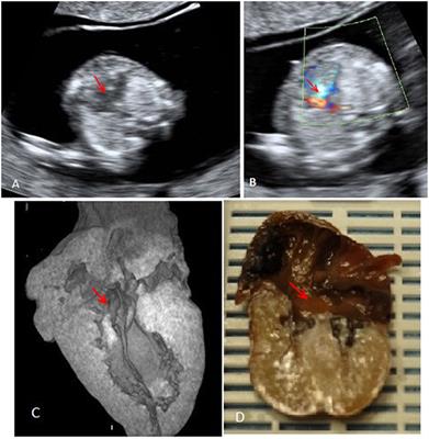 Accuracy of Micro-Computed Tomography in Post-mortem Evaluation of Fetal Congenital Heart Disease. Comparison Between Post-mortem Micro-CT and Conventional Autopsy.